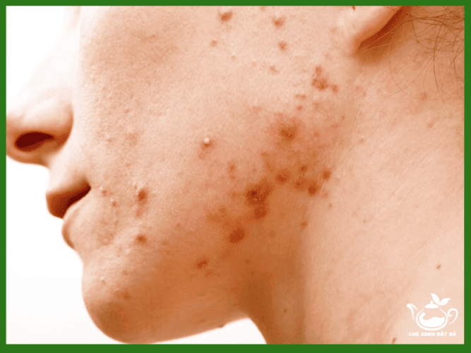 8 Tác dụng của bột diếp cá